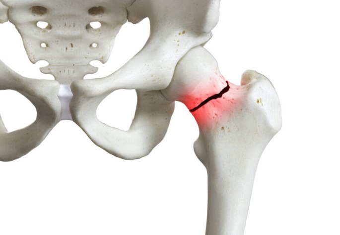 Fratura do colo de fêmur por osteoporose. Aqui você encontra dicas para prevenir as quedas.